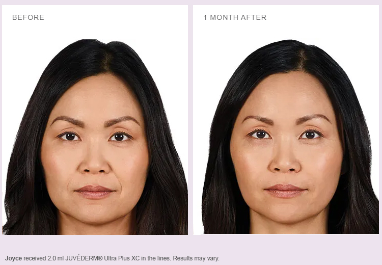 teosyal-vs-juvederm-what-is-juvederm-juvederm-Canada