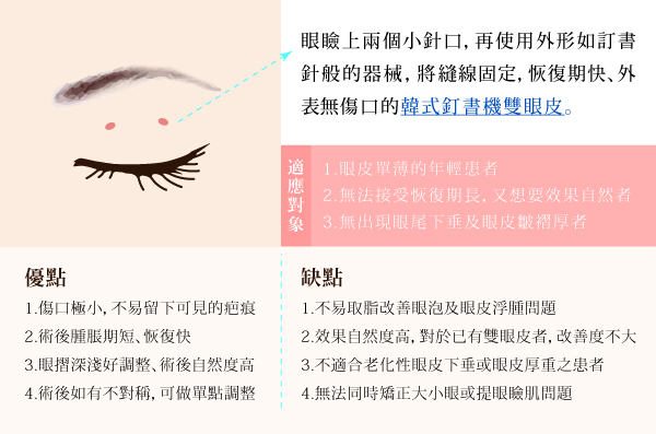 雙眼皮手術-內文圖-釘書機-0217